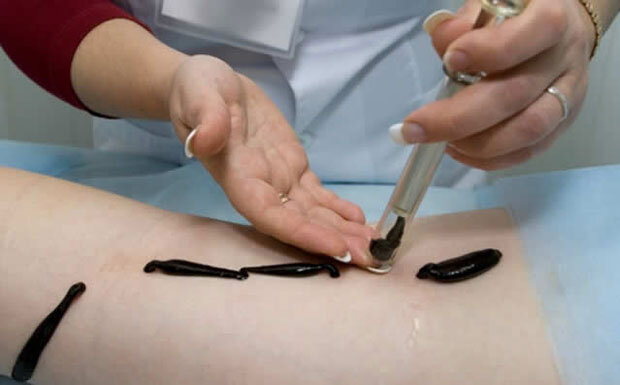 Гирудотерапия при варикозе