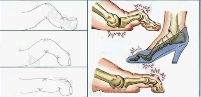 Не сгибается палец на ноге. Плоскостопие молоткообразная деформация. Молоткообразная деформация пальца ноги. Молоткообразные пальцы деформации. Молоткообразная деформация 2 пальца на ноге.