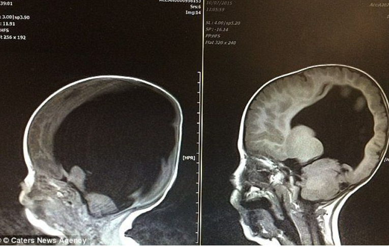 Этот мальчик родился практически без мозга. Как складывается его жизнь и как он выглядит в свои 9 лет