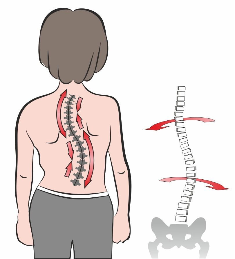 S-образный сколиоз - лечение без операции