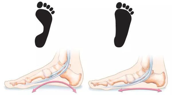 При плоскостопии наступает сглаживание естественных, характерных для здорового человека анатомических вогнутостей — сводов стопы (probolezny.ru)