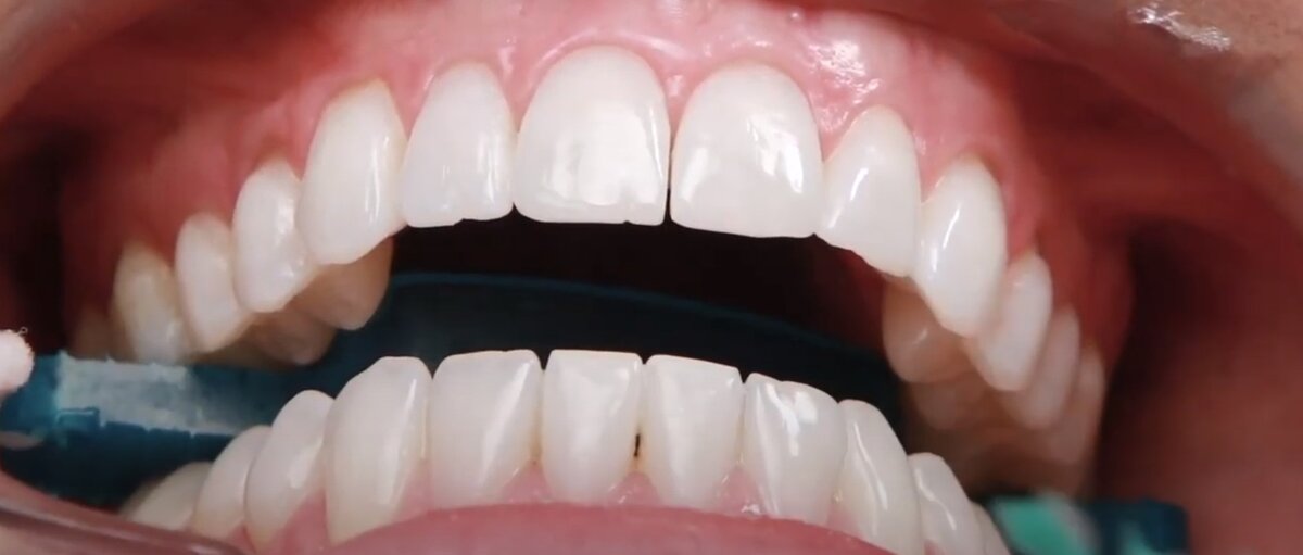 Отбеливание зубов по технологии Opalescence