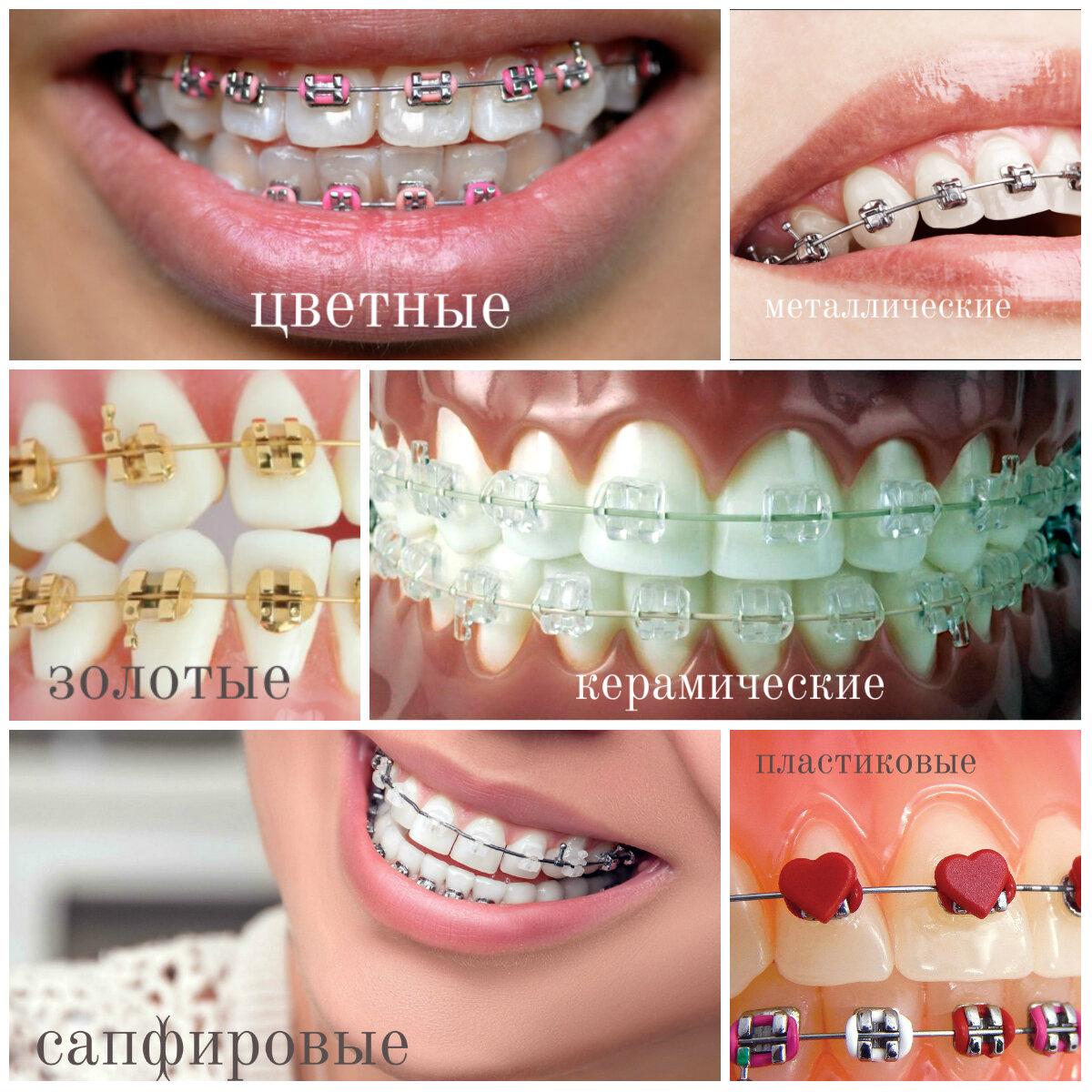 Внешний вид разных типов брекетов