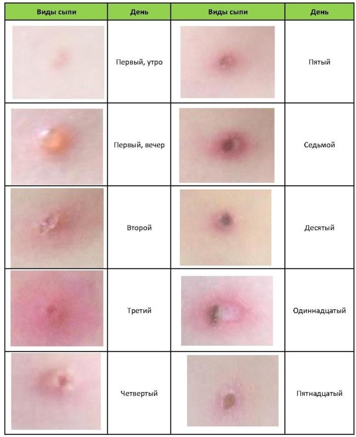 Вот приблизительно так выглядела динамика развития сыпи.