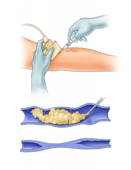 Склеротерапия: склеивание вен