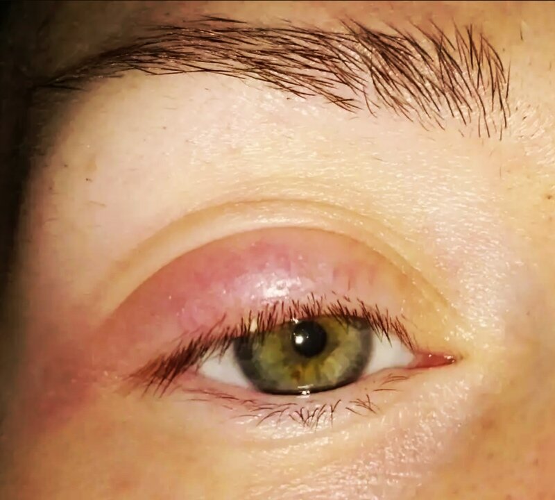 Отек на веке