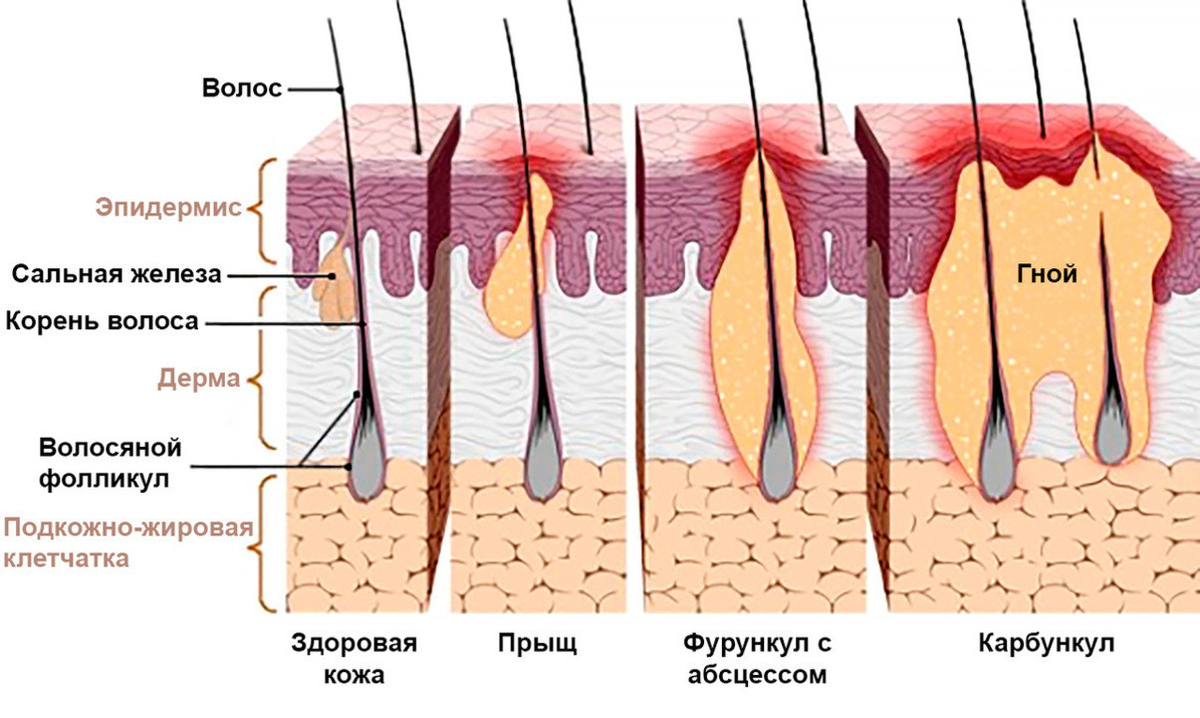 Фурункулы и карбункулы — главное, что нужно знать | Evolutis Clinic | Дзен