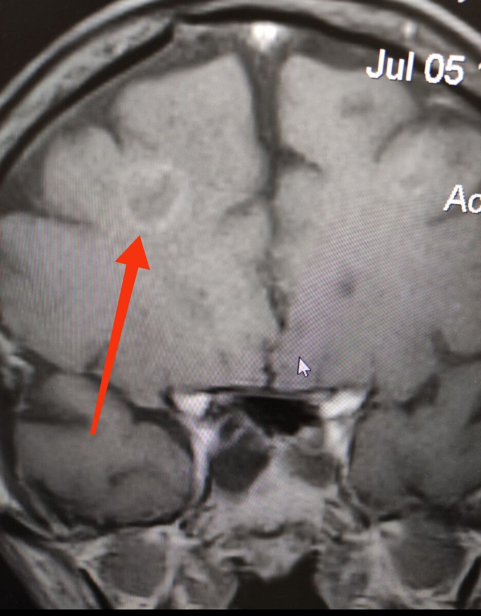 МРТ головного мозга с контрастированием