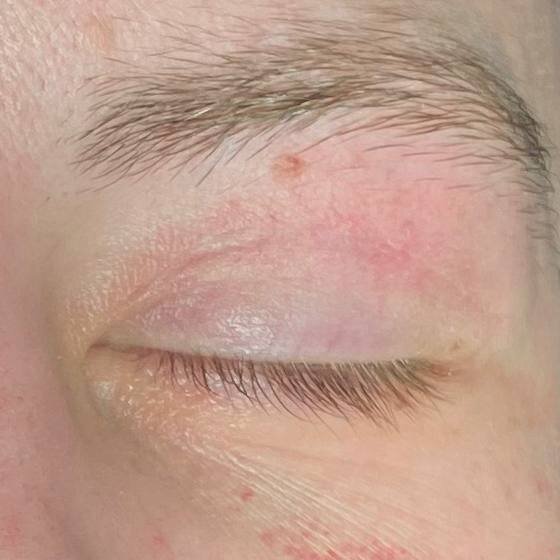 Вид рубца на 12 день после операции 