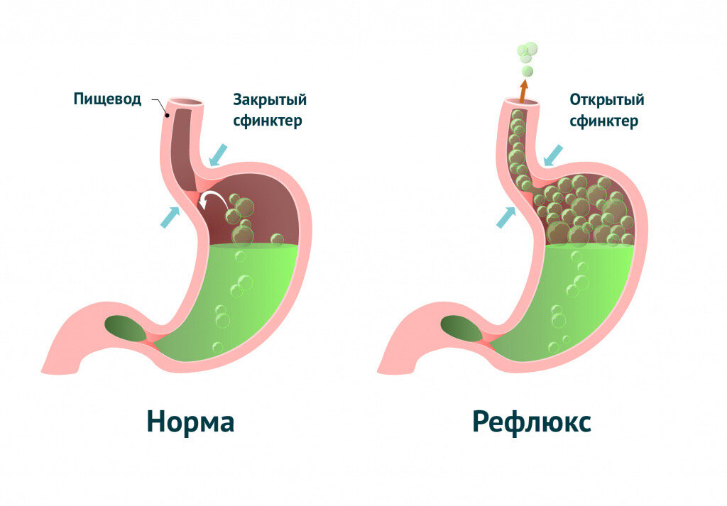 Слабость нижнего пищеводного сфинктера пищевода ведёт к регулярному забросу желудочного сока в пищевод, из-за этого возникает воспаление и рефлюкс-эзофагит