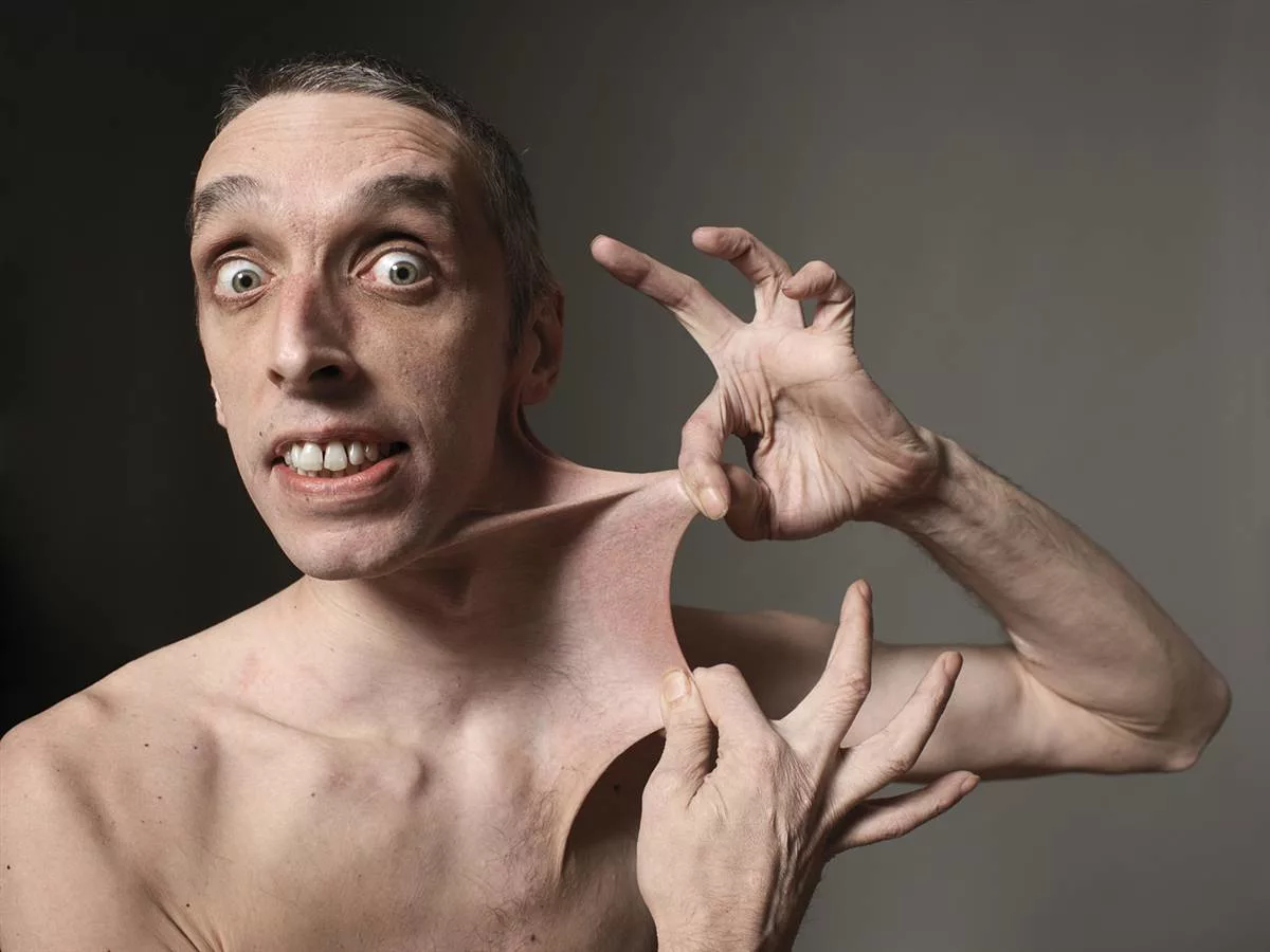 Гарри Тернер - один из обладателей эластичной кожи