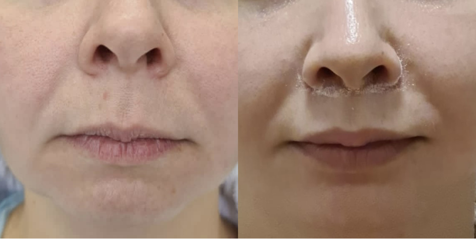 Фото из личного архива хирурга Д.Р.Гришкяна, имеются противопоказания, требуется консультация специалиста.