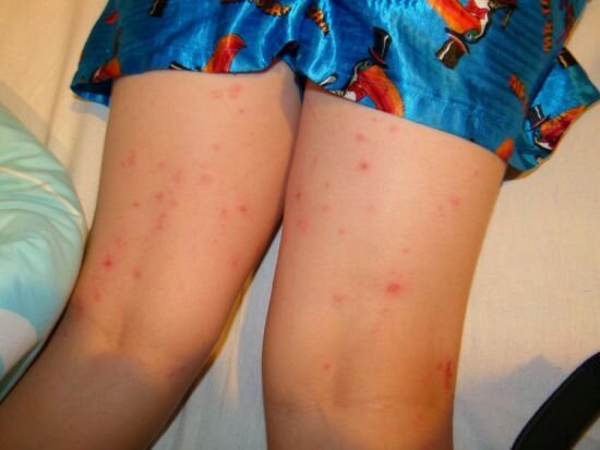 
В месте укуса появляется покраснение, а кожа сильно чешется