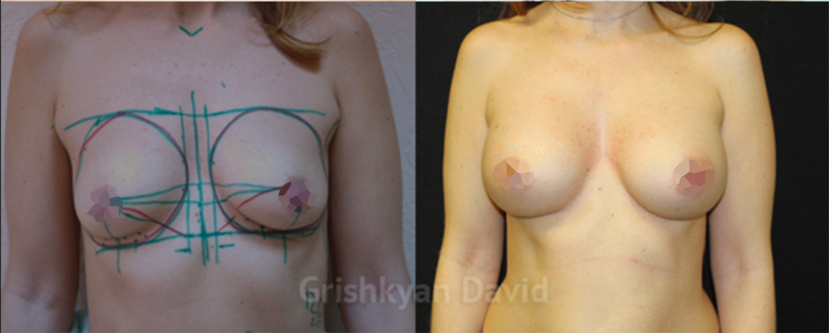 Результата до и после протезирования груди имплантации кампании «Ментор». Как проходит процедура можно посмотреть видео в конце статьи.