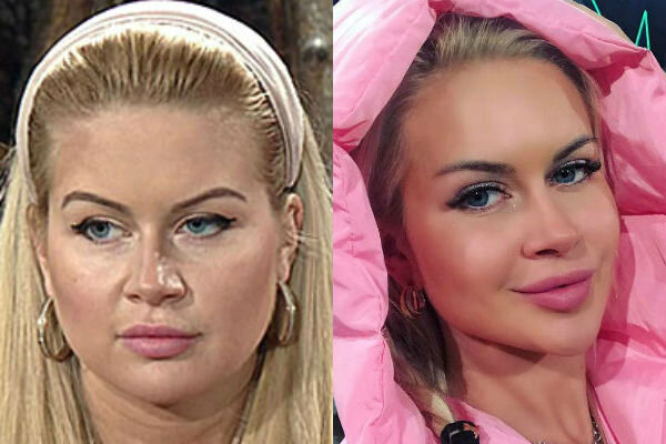 Африкантова до и после пластики