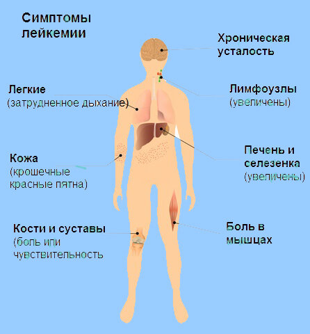 Симптомы лейкемии