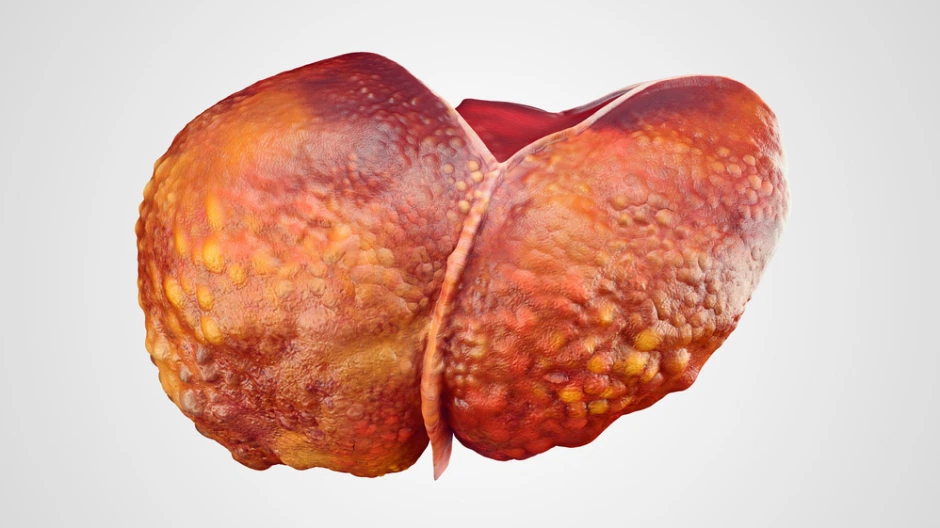 Цирроз печени - результат длительного воздействия разрушающих факторов