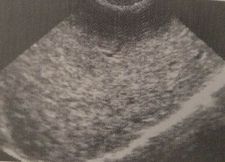 Яркий пример выраженных диффузных изменений печени - микронодулярный цирроз печени