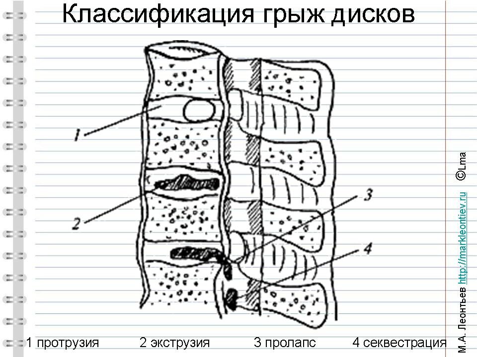 Виды дегенеративных изменений межпозвонковых дисков