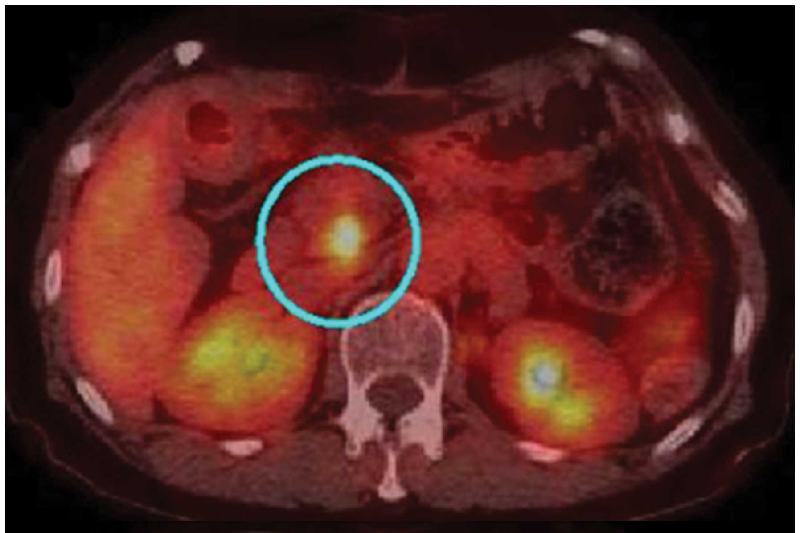 Как и другие опухоли, эта опухоль рака поджелудочной железы, показанная на ПЭТ-сканировании, может подвергаться возрастающему давлению со всех сторон по мере ее роста. Эксперименты показывают, что такое сжатие повышает лекарственную устойчивость.