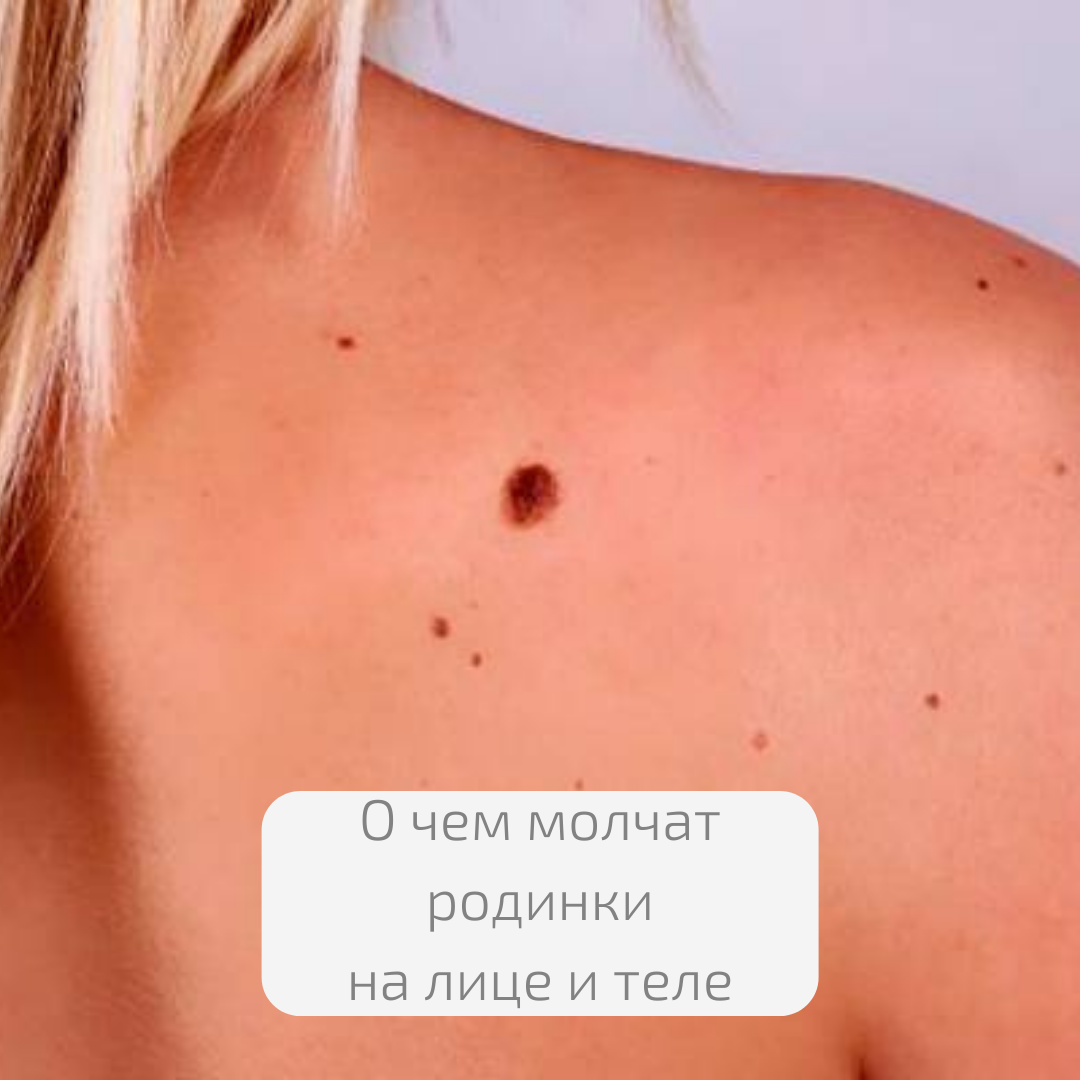 День профилактики меланомы кожи. Памятка косметолога. | Tori Clinic | Дзен