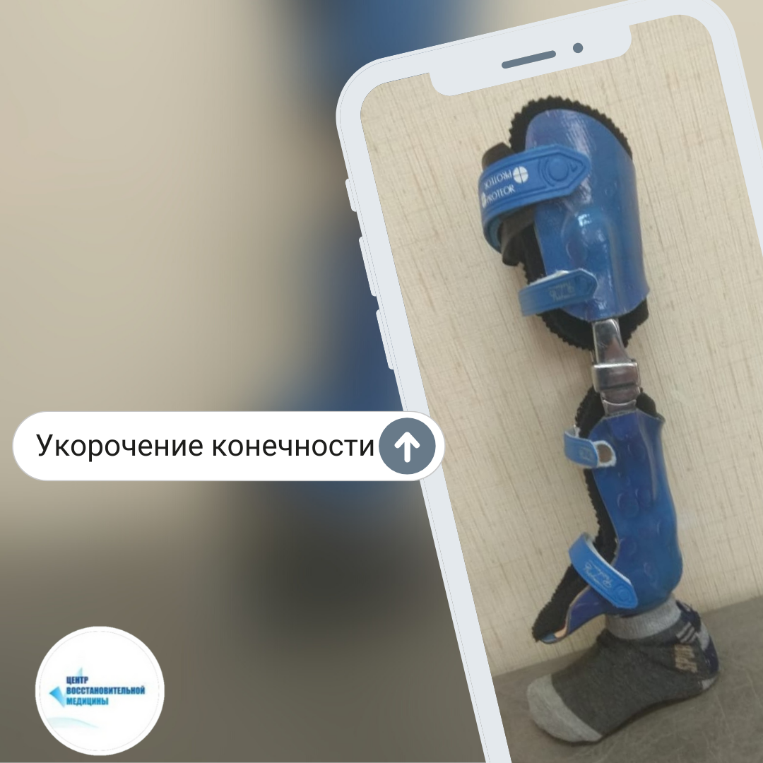 Аппарат при укорочении конечности