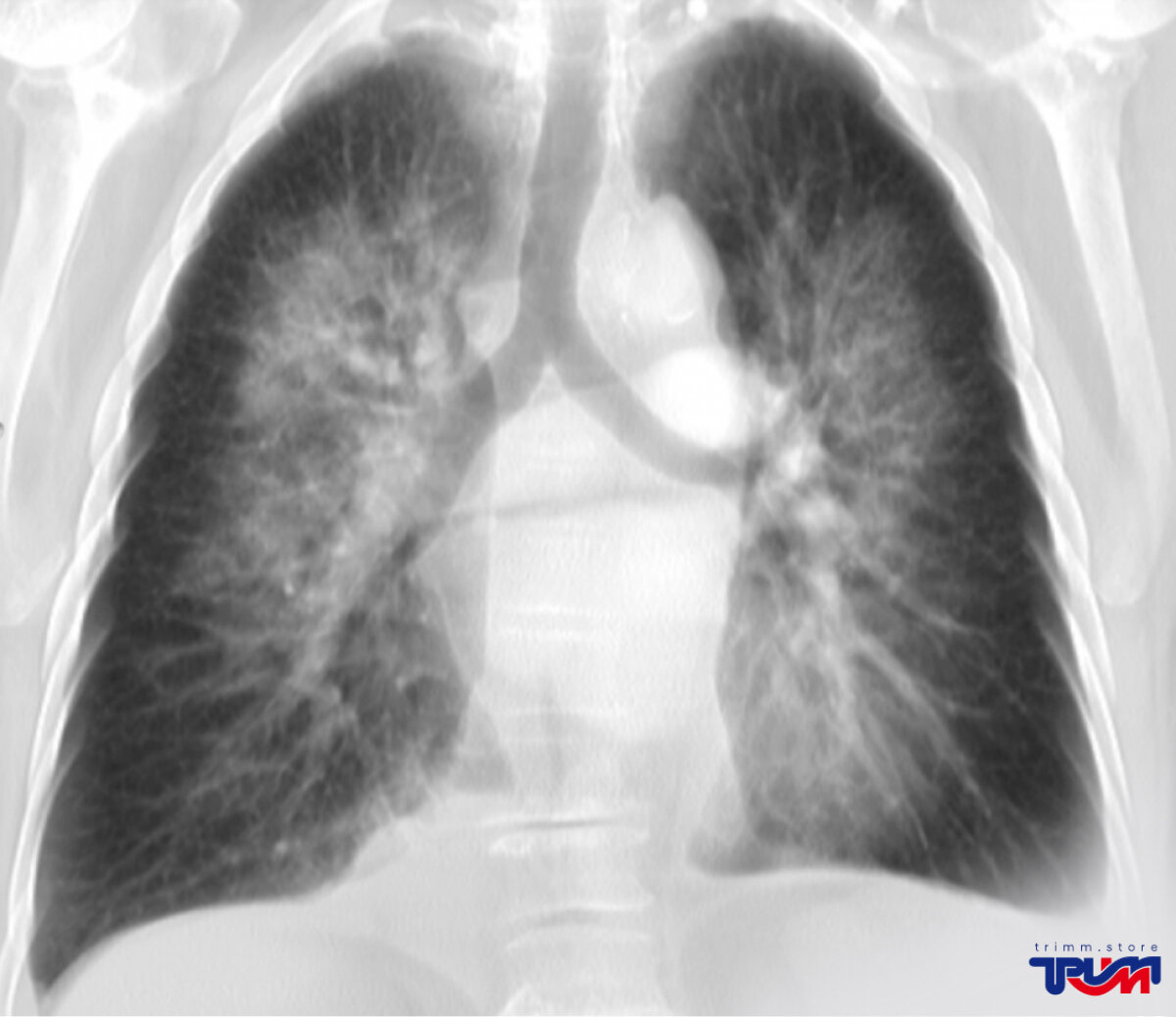 Отечность легких. Кардиогенный отек легких рентген. Отёк лёгких рентгенологическая картина. Токсический отек легких рентгенограмма.