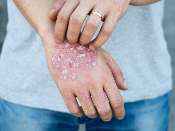 Грибковые заболевания кожи (микозы) – патологии, с которыми люди сталкиваются регулярно. Подобные поражения занимают первое место среди всех болезней инфекционного характера. Такая распространенность патологии обусловлена тем, что далеко не все знают, как правильно проводить профилактику микозов, и что делать, если они возникли.

На самом деле, следует просто своевременно обратиться к врачу и не допускать развития запущенных форм грибковых заболеваний. На ранних стадиях все микозы успешно и достаточно быстро лечатся. Сегодня существуют отработанные методики, позволяющие устранить как внешние симптомы патологии, так и причины, спровоцировавшие ее развитие. Не стесняйтесь своей проблемы!