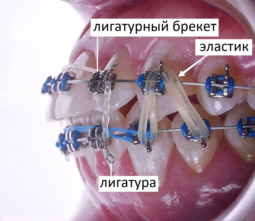 Устройство брекетов наглядно | Proxima Clinic I Ортодонтия и стоматология I  СПб | Дзен