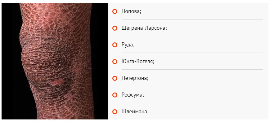 ихтиоз кожи является одним из признаков наследственных синдромов 