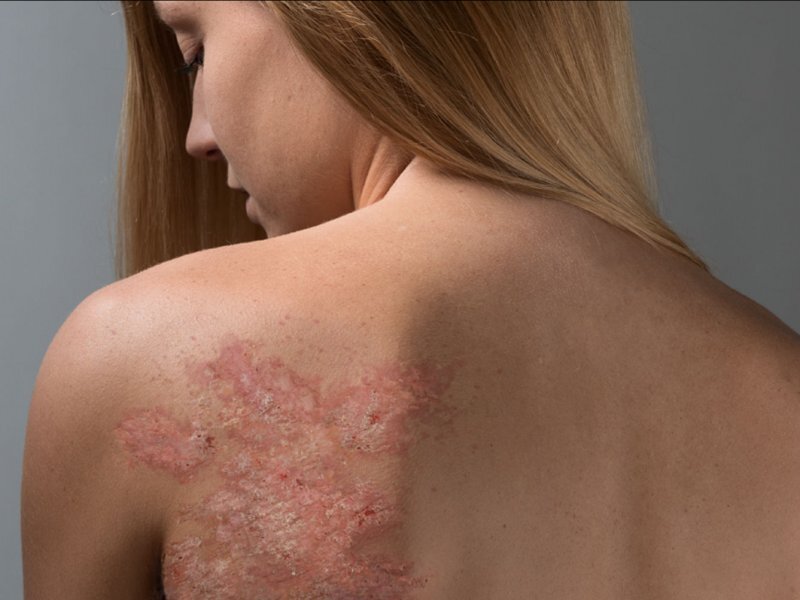 псориатические бляшки на лопатке у девушки