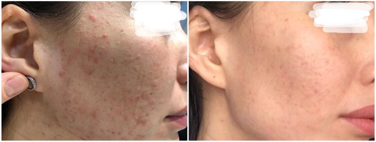 До и в процессе лечения акне средней степени тяжести
