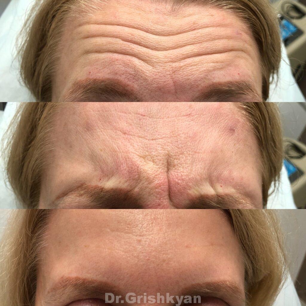 Результат ботокса до и после. Фото с сайта Д.Р. Гришкяна. Имеются противопоказания, требуется консультация специалиста