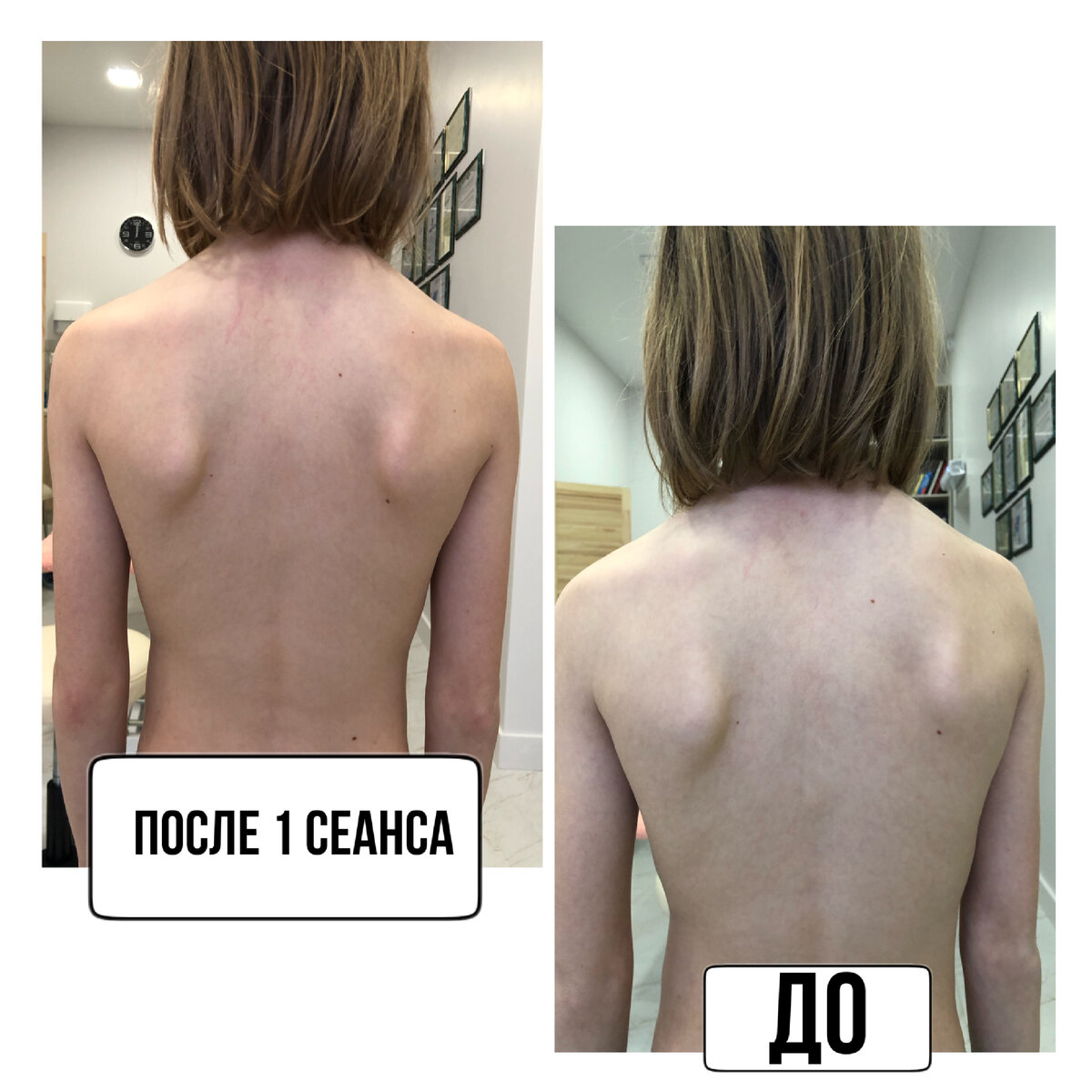 Остеопатическая коррекция осанки по методу «остеобиометрика» (Патент РФ)