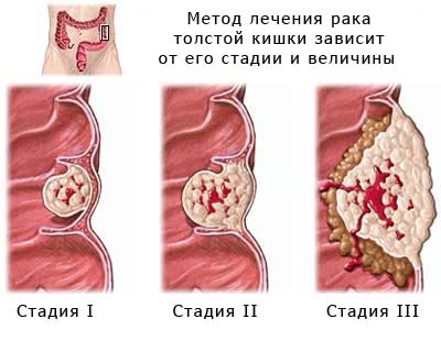 Диагностика и лечение воспалительных заболеваний кишечника