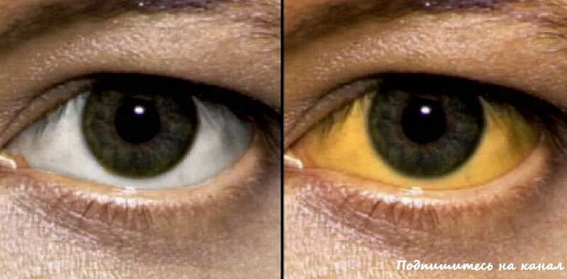 Почему глаза желтоватого. Синдром Жильбера склеры. Синдром Жильбера желтуха.