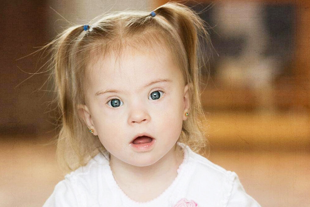 Ребенок с Синдромом Дауна