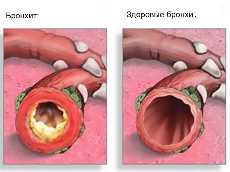 Народная медицина: Острый и обструктивный бронхит