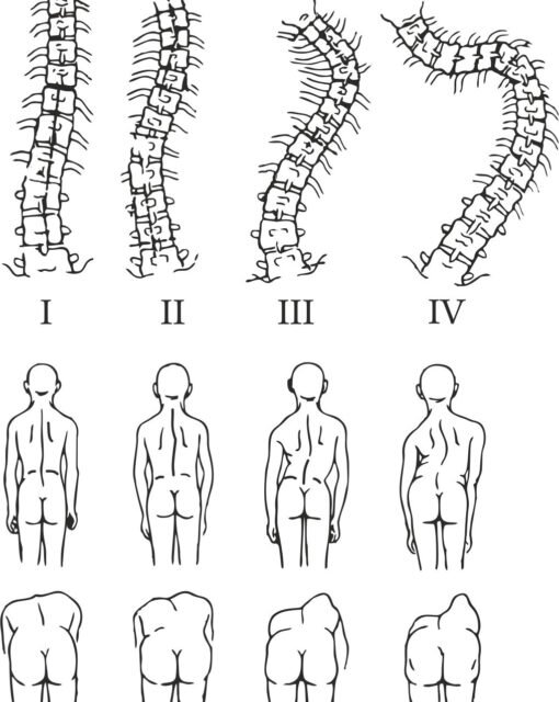 С какой степенью искривления не берут на службу