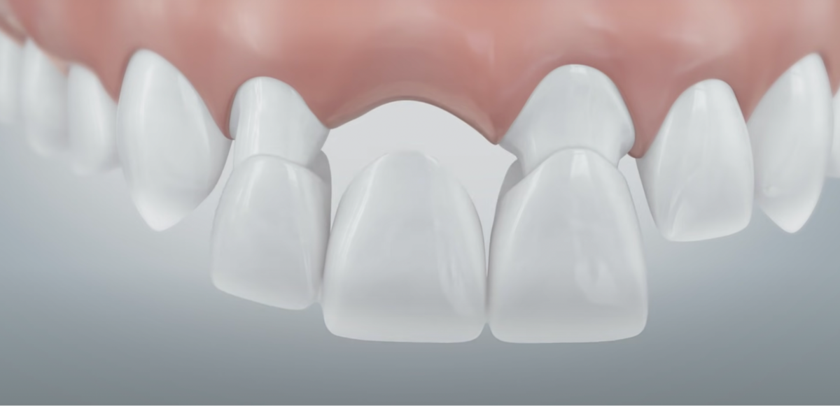 Зубной мост на опорных зубах