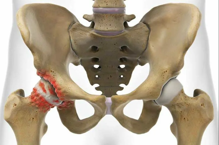Суставы таза женщины. Коксалгия тазобедренного сустава. Коксартроза тазобедренного сустава. Тазобедренный сустав анатомия коксартроз.