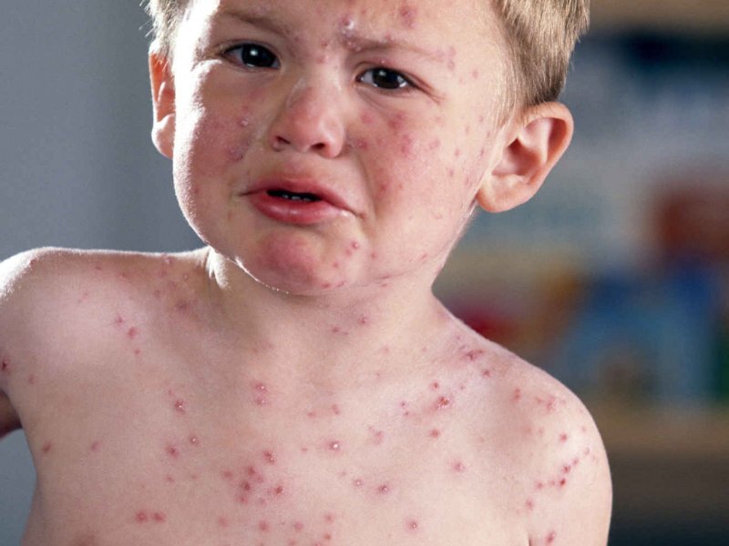 Вирус Коксаки у детей: чем опасен, симптомы и как лечить?