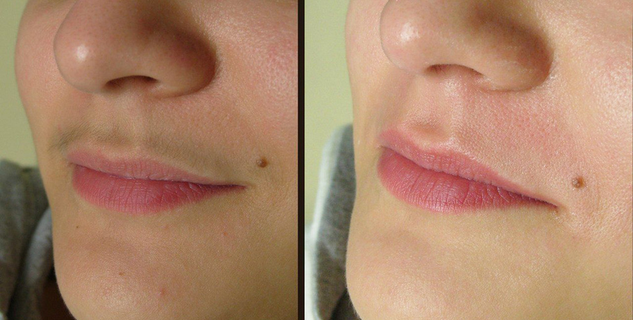    Многим женщинам знакома проблема оволосенения на лице, в частности в области над верхней губой. Смотрится это нелепо и не эстетично, особенно если волоски темного цвета, вызывают комплексы.-2