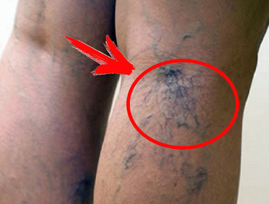 варикоз, лечение варикоза, признаки, симптомы, варикозные расширение вен