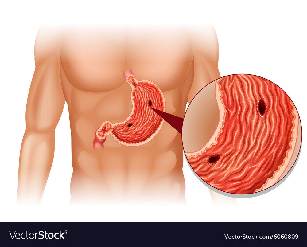 Язвой желудка называют деструктивное поражение стенки этого органа ЖКТ.  Разрушение затрагивает как слизистую, так и нижележащие слои стенки, в том числе: соединительнотканную и мышечную.-2