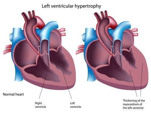 Лечение гипертрофии левого желудочка сердца