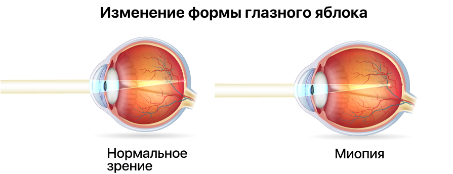 Зрение плюс отзывы. Близорукость это плюс или минус. Зрение при астигматизме. Ухудшилось зрение в даль. Почему портится зрение.