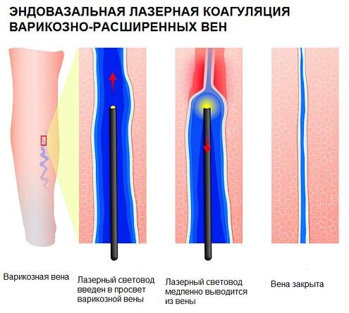 Изображение с сайта gkb-24.ru. Метод ЭВЛК. 