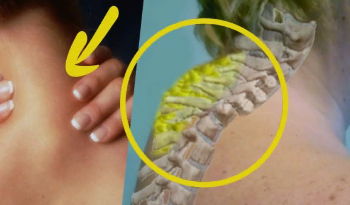 Как выглядит горб на шее