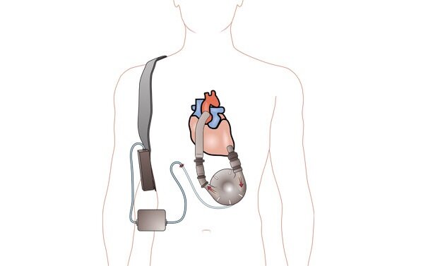 LVAD (желудочковое вспомогательное устройство)